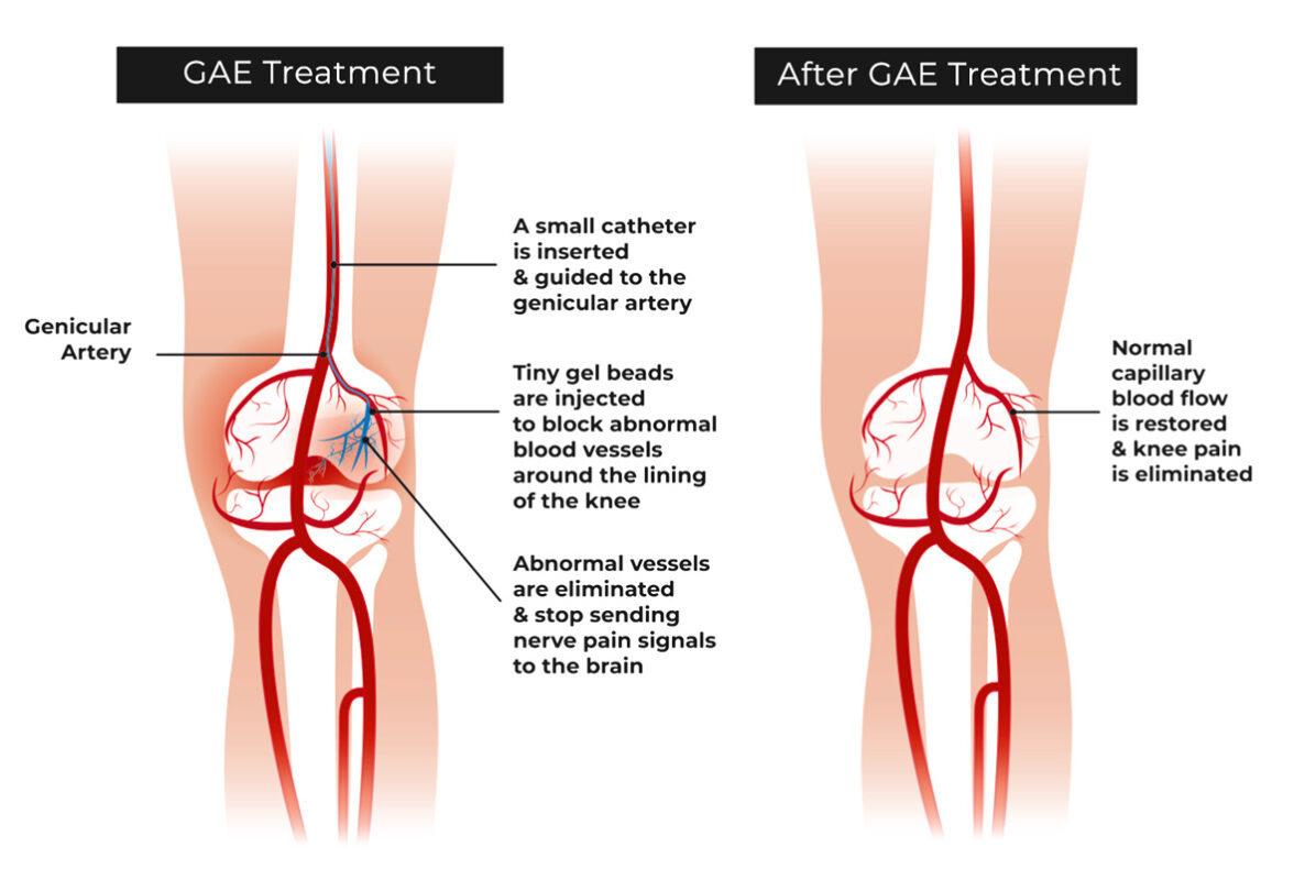 GAE procedure schematic showing embolization of genicular arteries